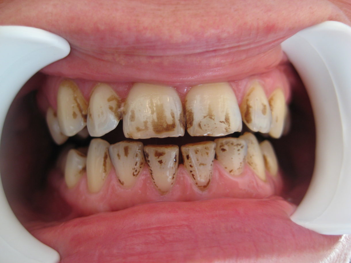 ¿Qué causan las manchas en los dientes? – Dental Zihuatanejo | Tu salud